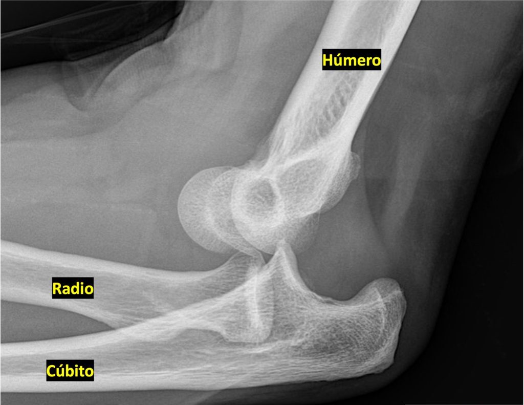 Luxaciones De Codo Del Campus Ortopedia