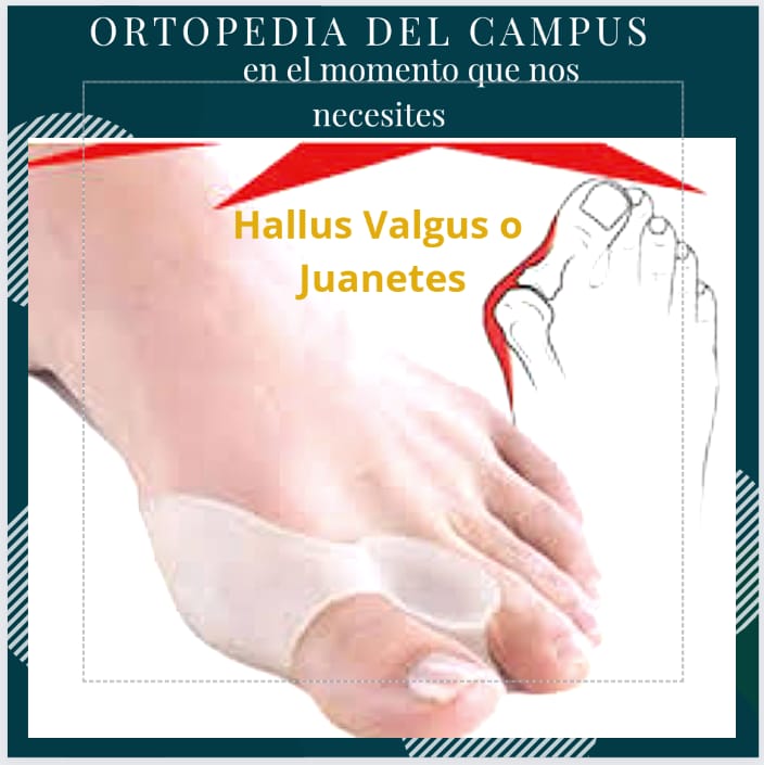 Hallus Valgus o Juanetes