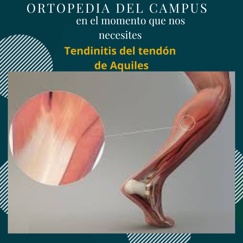 Tendinitis de Aquiles