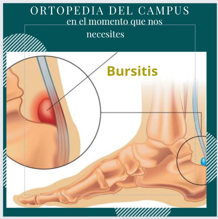 Bursitis Retrocalcánea
